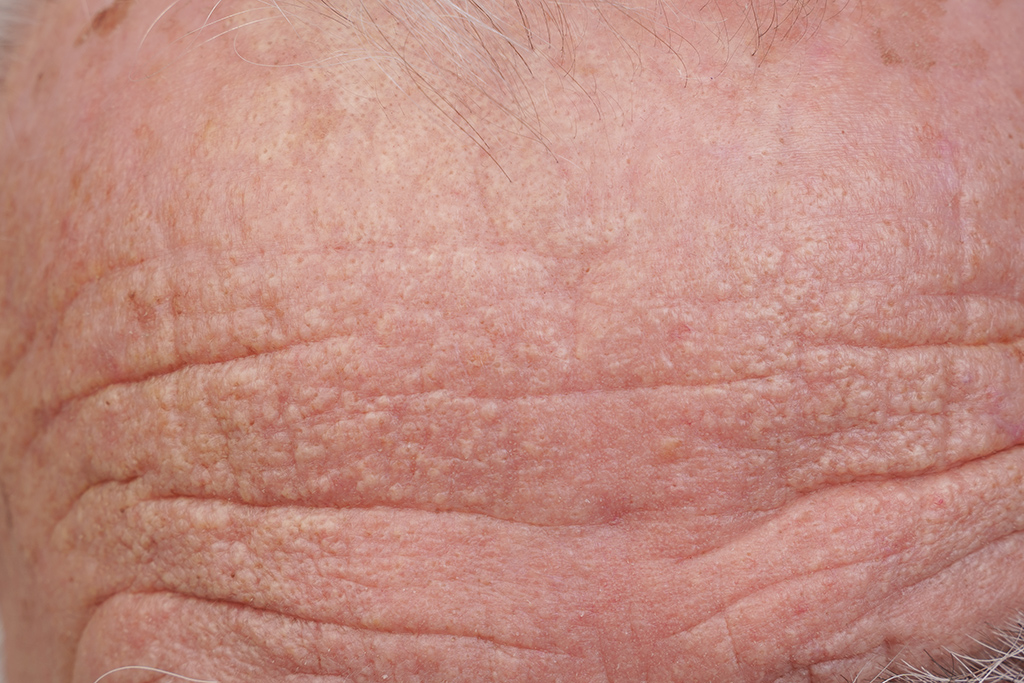 solskade - skadesfotografering